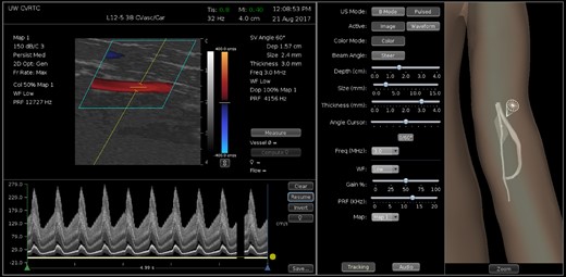 Vascular Doppler simulator interface showing scan of a dialysis access shunt model. The location and orientation of the image plane are indicated in a 3D reconstruction of the shunt that is displayed in the visual guidance display (right panel). The gray sphere indicates the position of the sample volume, and the red and green curves indicate the centerlines of the artery and vein. The middle panel displays parameter settings. Volume flow has been measured from the diameter of the vein and blood flow velocity over four cardiac cycles (left panel). A measurement of peak systolic blood flow velocity is also displayed.