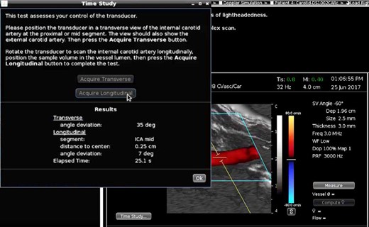 Dexterity test. The trainee has acquired a transverse view of the internal (ICA) and external carotid arteries, rotated to a longitudinal view of the ICA, and positioned the sample volume in the center of the ICA lumen. The test results report the accuracy and speed of the trainee.