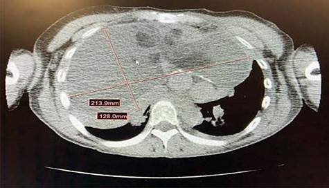 Large missed attenuation anterior mediastinal mass measuring approximately 21.4 cm x 12.8 cm. The mass had a large fluid component with loculations and scattered areas of fat. There were also scattered wall calcifications of the mass. There was leftward shift of the heart secondary to mass effect and the tumor was noted to be in close proximity to arch vessels as well as the SVC.