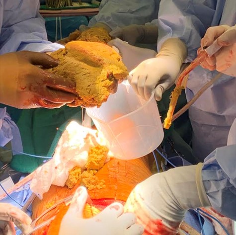 Copious amounts of cheesy, granular material removed with careful dissection.