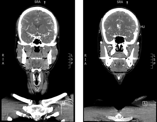CTA head/neck. Asymmetric small caliber of the right-sided anterior circulation with venous engorgement versus collateral flow at the right sylvian fissure (left) and pericallosal region (right) concerning for moyamoya.