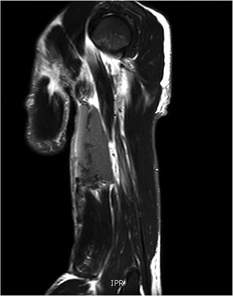 T2 sagittal view of complete biceps brachii muscle belly transection.