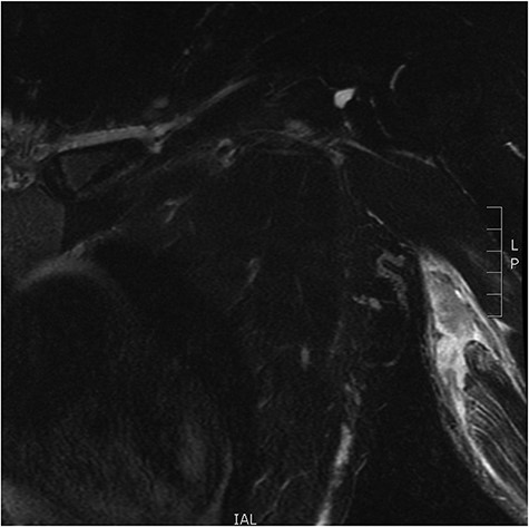 Coronal view of complete coracobrachialis rupture on T2 magnetic resonance imaging image.