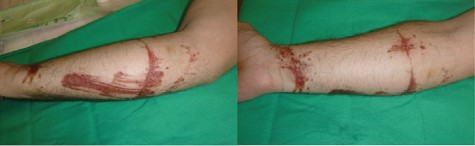 Wounds on day seven following injury.
