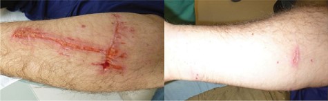 Wounds on day fourteen following injury.