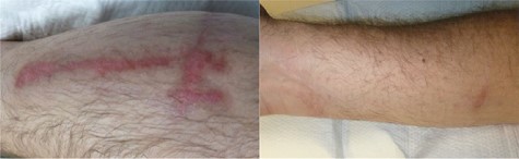 Wounds one month following injury.