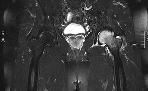 Coronal T2 sequence demonstrating significant bone marrow edema of the left femoral head with evidence of bone.