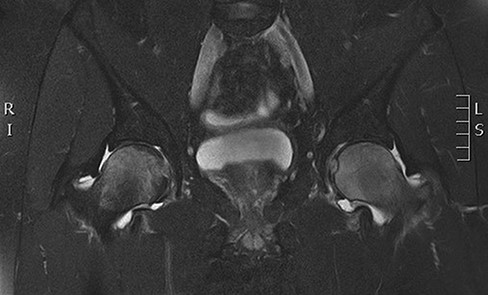 Coronal T2 sequence demonstrating bone marrow edema of the left femoral head with evidence of worsening bone.