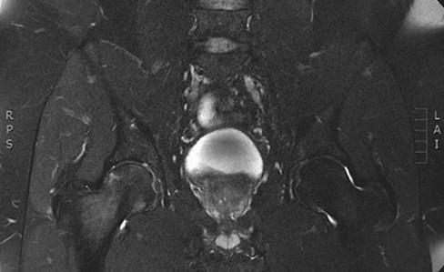 Coronal T2 sequence demonstrating near complete resolution of bone marrow edema of the left proximal femoral head.