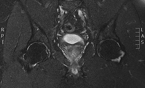 Coronal T2 sequence of the bilateral hips approximately 9 months Status post initial complaint demonstrating interval resolution of previously seen bilateral femoral head and neck bone marrow edema.