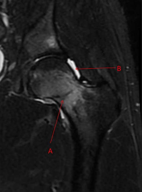 Coronal STIR magnetic resonance imaging image demonstrating femoral neck stress fracture beginning at the subcapital region of femoral neck at the femoral head and neck junction and propagating in a horizontal orientation toward the superior femoral neck (Arrow A). There is an associated hip effusion present (Arrow B).