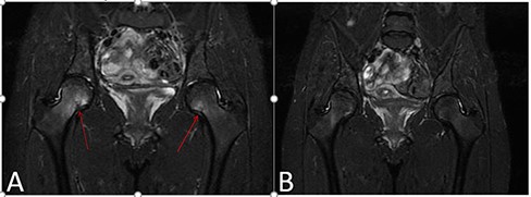 Case 1. (A) Coronal Short tau inversion recovery (STIR) magnetic resonance imaging sequence of bilateral hips demonstrating a bilateral subcapital femoral neck stress fracture involving approximately 30% of the femoral neck width on the right and 25% on the left. (B) Follow-up coronal STIR magnetic resonance imaging sequence obtained 4 weeks later after a period of activity modification, demonstrating healing of the aforementioned femoral neck stress fractures.