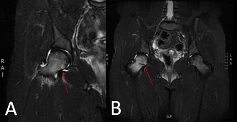 Case 2. (A) Initial coronal STIR magnetic resonance imaging demonstrating focal bone marrow edema in the right subcapital femoral neck region with a compression-sided fracture line extending approximately 26% across the femoral neck with an associated hip effusion. (B) Coronal STIR magnetic resonance imaging sequence obtained 9 days later due to the presence of initial hip effusion, demonstrating progression of the femoral neck stress fracture involving approximately 66.7% of the right femoral neck width with increased surrounding diffuse marrow edema.