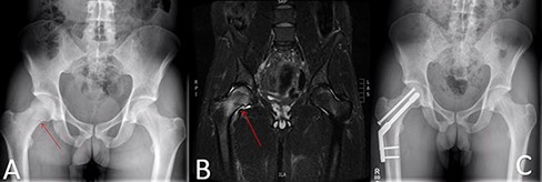 Case 3. (A) Anterior/Posterior pelvis radiograph demonstrating an area of sclerosis of the right compression side of the femur in the subcapital region. (B) Coronal STIR magnetic resonance imaging image demonstrating a subcapital femoral neck stress fracture extending approximately 84% of the femoral neck width with an associated femoral neck effusion. (C) Postoperative image demonstrating dynamic hip screw.