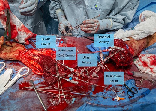 The amputated limb and residual extremity after arterial and venous shunting with ECMO cannula placement. Abbreviation: ECMO, extracorporeal membrane oxygenation.