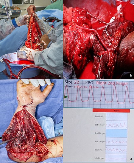 (A) The open reduction and internal fixation of the ulna while the open ECMO circuit is perfusing the amputated forearm. (B) Radial and ulnar artery anastomoses. (C) Postoperative day 6 appearance of the reconstruction after repeat debridement. (D) Vascular Doppler studies of the digital arteries postoperative revealing perfusion of the thumb through the ring finger with appropriate waveforms. Abbreviation: ECMO, extracorporeal membrane oxygenation.