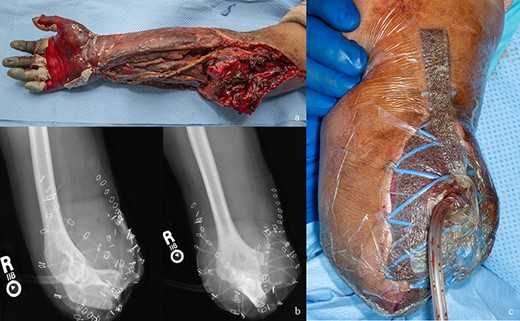 (A) Appearance of the replanted forearm before amputation. (B) Postoperative radiographs showing high transradial amputation. (C) Clinical photograph of transradial amputation.