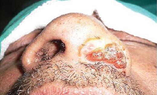 Clinical photograph showing polypoidal mass protruding from the left nasal cavity.