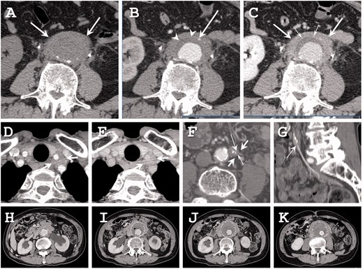 Radiographic findings. (a–c) Seventy-three-year-old man with IgG4-related periaortitis. (a) Precontrast CT shows the soft tissue density mass around the abdominal aorta (white arrows). (b) The arterial phase of dynamic contrast-enhanced CT shows the inferior mesenteric artery in the soft tissue density mass (thin arrow). The atherosclerotic plaque is not enhanced (arrowheads). (c) The delayed phase of dynamic contrast-enhanced CT shows that the periaortic mass is slightly enhanced (arrows). A high density thin layer is seen between the atherosclerotic plaque and the periaortic mass (small arrows). (d,e) A 68-year-old man with IgG4-related periarteritis. (d) The arterial phase of dynamic contrast-enhanced CT shows a soft tissue density mass around the left common carotid artery (arrows). (e) The delayed phase of dynamic contrast-enhanced CT shows that the mass is slightly enhanced (arrows). Stenosis of the left common carotid artery is not seen in this case. (f,g) A 63-year-old man with IgG4-related periarteritis. (f) The arterial phase of dynamic contrast-enhanced CT shows a soft tissue density mass around the inferior mesenteric artery (arrows) with a luminal stenosis (thin arrow) and calcification (small arrow). (g) In the reconstructed sagittal image, the luminal stenosis can be clearly seen (thin arrow). (h–i) IgG4-related abdominal inflammatory aneurysm treated by stent graft implantation.