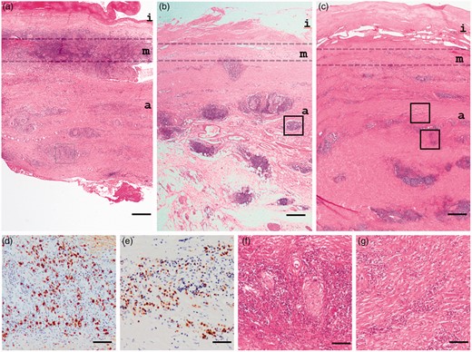 Histopathological findings of IgG4-related abdominal aortic aneurysm. (a) Inflammation with lymphoplasmacytes is observed predominantly in the medial layer. (b) Diffuse inflammation with lymphoid follicles and fibrosis are detected mainly in the adventitia layer that is in part spreading to adjacent adipose tissue. (c) Fibrosis progresses to adjacent adipose tissue. (d,e) Massive infiltration of IgG4-immunopositive cells in adventitia (d and e correspond to box areas of a and b, respectively). (f) Perineural infiltration. (g) storiform fibrosis. A higher magnification of the box area of (c). Original magnifications and scale bar, respectively, are ×12.5 and 500 μm (a–c), ×200 and 50 μm (d, e), and ×100, and 100 μm (f, g). i, intima; m, media; a; adventitia.