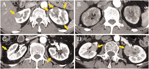 A variety of contrast-enhanced computed tomography (CT) findings in IgG4-related kidney disease. (A) Multiple low-density lesions in the bilateral kidneys (arrows); (B) Diffuse patchy involvement of the bilateral kidneys; (C) Rim-like lesion of the kidney (arrows); (D) Renal pelvis thickening with smooth intraluminal surface (arrows).