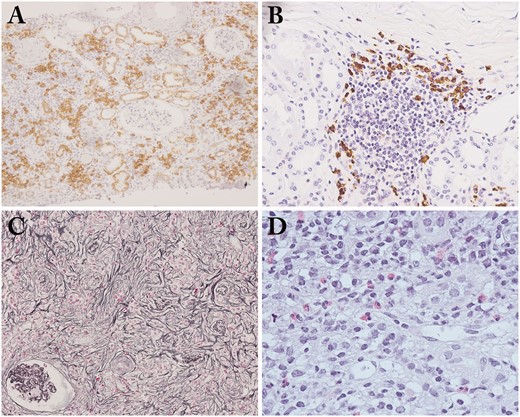 Light microscopy findings in IgG4-related tubulointerstitial nephritis. (A) Copious plasma cell infiltrates in the interstitium (CD138 immunostaining × 100); (B) Many IgG4-positive plasma cell infiltrates with germinal center in the subcapsular interstitium (IgG4 immunostaining ×200); (C) a representative example of storiform fibrosis (periodic acid-methenamine-silver staining ×100); (D) Many eosinophil infiltrates in the interstitium (hematoxylin and eosin staining ×400).