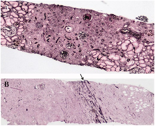 The specific distribution of renal parenchymal lesions. (A) The margin between affected and unaffected areas is very clearly demarcated (periodic acid-methenamine-silver staining ×40); (B) Lymphoplasmacytic cells infiltrate into and beyond the renal capsule (arrow: renal capsule) (periodic acid-methenamine-silver staining ×40).