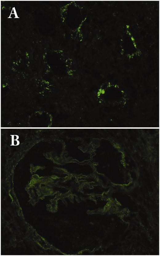 Immunofluorescence findings. (A) Granular deposits of C1q in the tubular basement membrane (×200); (B) Granular deposits of IgG4 in the glomerular basement membrane in IgG4-related membranous glomerulonephritis (×400).