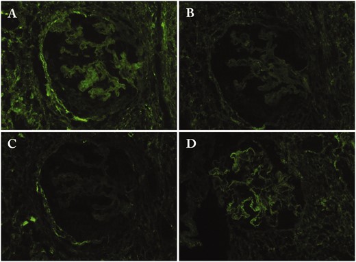 Immunofluorescence findings of the glomerulus in a patient with IgG4-related membranous glomerulonephritis. (A) IgG1; (B) IgG2; (C) IgG3; (D) IgG4.