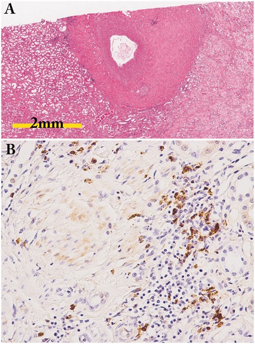 Periarterial lesion and perineural lesion. (A) Marked periarterial fibrosis of interlobar artery (periodic acid-Schiff staining); (B) IgG4-positive plasma cell infiltration in the perineural lesion in a patient with IgG4-ureteritis who underwent nephrectomy (IgG4 immunostaining ×400).