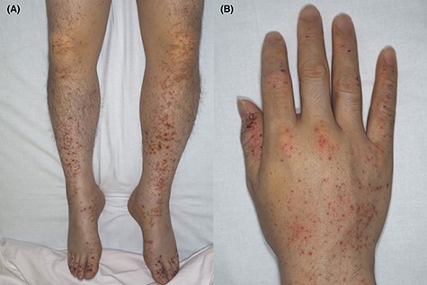 Palpable purpura on the lower limbs (A) and right hand (B) (Case 1).