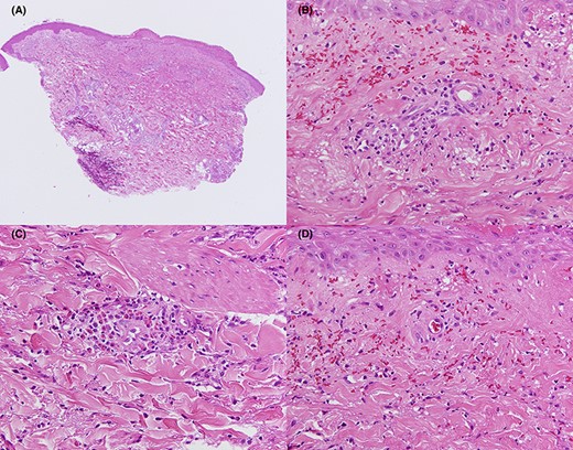 Histopathological study of the patient’s right forearm (Case 1). Erosions are seen on some parts of the epidermis (A). Inflammatory infiltration of neutrophils and lymphocytes, extravasation of red blood cells, and nuclear debris (B) and inflammatory infiltration of eosinophils (C) in the perivascular area. Fibrinoid necrosis is also noted (D). (A) Haematoxylin and eosin staining, ×40. (B–D) Haematoxylin and eosin staining, ×400.