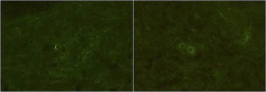 Immunofluorescence studies of the patient’s right forearm (Case 1). No definite deposits of IgA (A) and only slight deposits of C3 (B) of the vessel walls were observed.