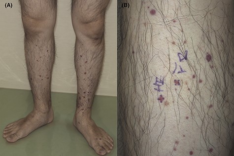 Palpable purpura on the lower limbs (A, B) (Case 2). The skin biopsy was taken from the purpura of the right lower leg (B).