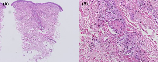 Histopathological study of the patient’s right lower leg (Case 2). Inflammatory infiltration of neutrophils, extravasation of red blood cells, nuclear debris, and fibrinoid necrosis are seen in the perivascular area (A, B). (A) Haematoxylin and eosin staining, ×40. (B) Haematoxylin and eosin staining, ×400.