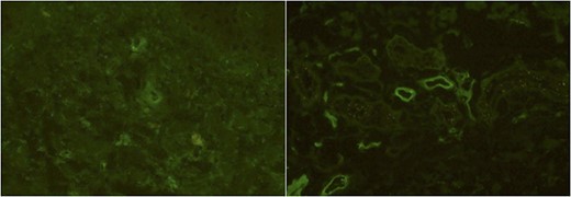Immunofluorescence studies of the patient’s right lower leg (Case 2). The slight deposits of IgA (A) and the deposits of C3 (B) of the vessel walls were observed.