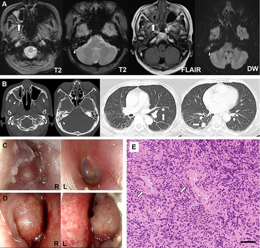 Imaging, clinical, and histopathologic findings. (a) Magnetic resonance imaging shows oedematous thickening of the maxillary sinus (arrows) and mastoid cells (arrowheads). (b) Computed tomography reveals soft-tissue shadows in the paranasal sinuses (arrowheads) and multiple nodules in the lungs (arrows). (c) Otoscopy demonstrates a bulging tympanic membrane with purulent effusion in the right ear. (d) Rhinoscopy shows swelling and erosion of the bilateral nasal mucosa. (e). Histopathologic examination of the nasal mucosa reveals vascular fibrin deposition (arrows) and granulation tissue with intensive infiltration of inflammatory cells, predominantly neutrophils. Black bar indicates 50 μm.