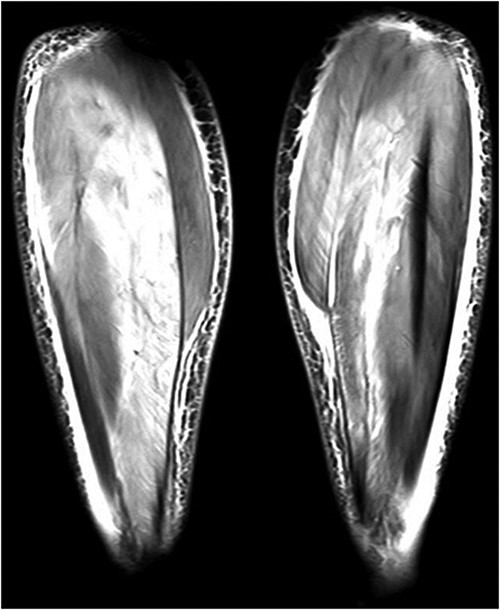 Lower extremity coronal MRI was compatible with myositis, an image showing prominent signal enhancements in posterior crural muscles, effusions, oedema in fasciae, and subcutaneous fat tissue.