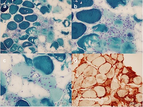 a–c: Necrotic muscle fibres and phagocytic cells near and within necrotic muscle fibres (Modified Gomori Trichrome) d: Notable MHC-I expression can be seen on the surface of all muscle fibres and it is increased in the cytoplasm of regenerating muscle fibres. Mononuclear cells are also stained with MHC-I marker.