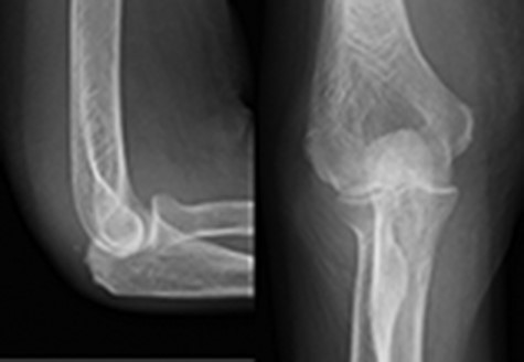 X-ray revealed a joint space narrowing of Larsen grade II at initial visit.