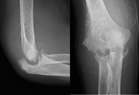 X-ray showed a progressive joint destruction.