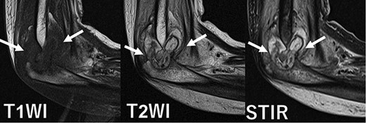 Magnetic resonance imaging showed joint effusion, bone marrow oedema, and synovial hyperplasia at white arrow.