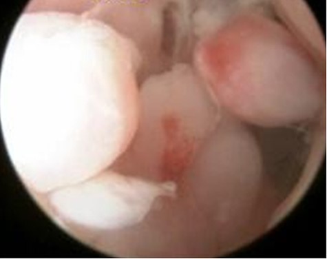 Arthroscopic findings showed generalised villous growth in her right elbow.