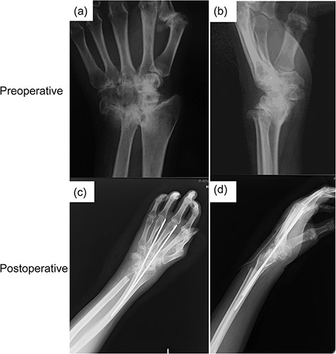 Radiography findings in Case 1.