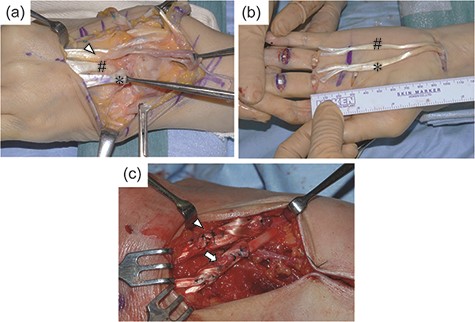 Intraoperative findings in Case 1.