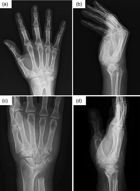 Radiography findings in Case 2.
