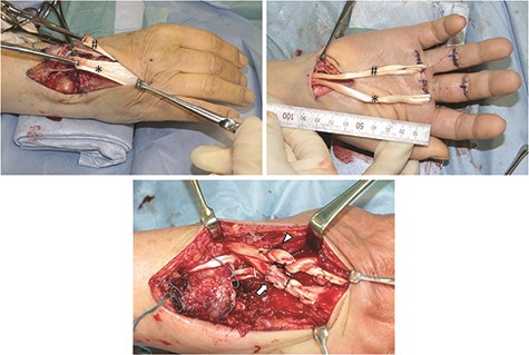 Intraoperative findings in Case 2.