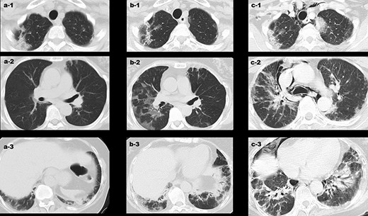Changes in the CT findings around the patient’s interstitial lung disease at various time points. (a) 13 days post-vaccination, interstitial opacities were observed at the apex and bottom of the lung; (b) 34 days post-vaccination, emergence of a new ground glass shadow and the shadow on the bottom of the lung were exacerbated; and (c) 46 days post-vaccination, the interstitial pneumonia shadow across the entire lung field was exacerbated, and there were clear signs of mediastinal emphysema.