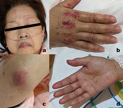 Catalogue of the skin lesions identified 19 days post-vaccination. (a) Erythema on both the forehead and pinna; (b) Gottron’s signs on the back of the hand and periungual erythema; (c) Gottron’s signs on the elbow; and (d) inverse Gottron’s signs on the palms.