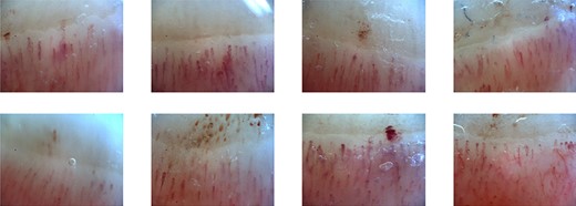 Nailfold capillary abnormalities as evaluated by NVC (OptiPix Capillaroscopy; Optilia Instruments AB, Sollentuna, Sweden). The NVC instrument facilitates a 200× magnification of the area allowing us to evaluate the nailfold capillaries for eight fingers, except thumbs, across both hands. These images revealed some vasodilation and only mild bleeding.